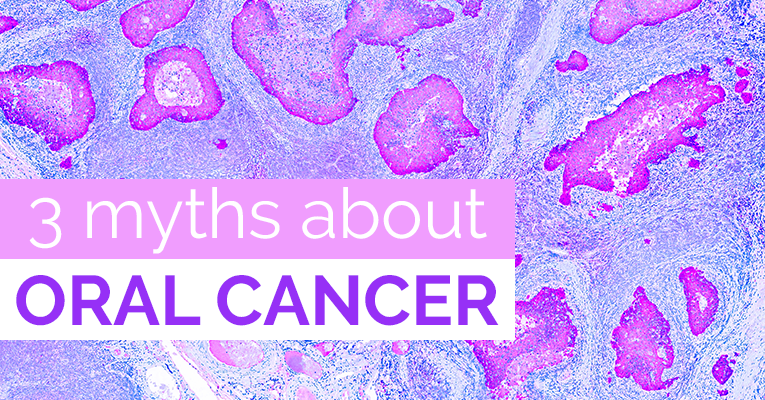 3 myths about oral cancer