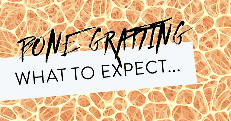 bone graft what to expect